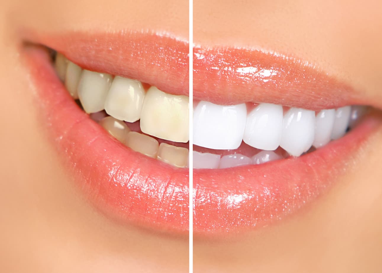歯が茶色くなるのは何故 虫歯 茶色くなる原因や白くする対処法とは 公式 歯のホワイトニング専門店ホワイトニングバー