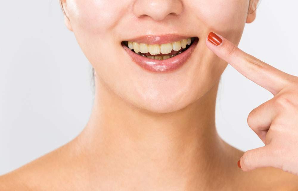 歯の食いしばりは黄ばみ・着色の原因になる