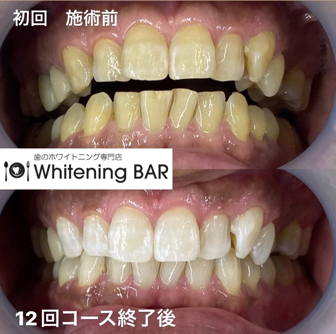 ホワイトニング ビフォーアフター 2023-09-01
