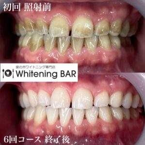 ビフォーアフターでわかる！ホワイトニングの変化